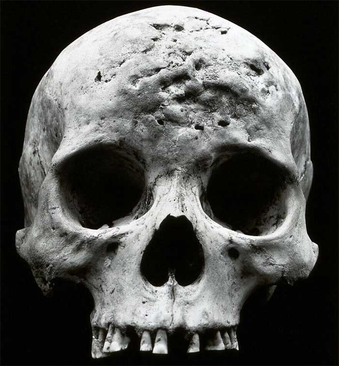 Effects of tertiary syphilis on a patient's skull