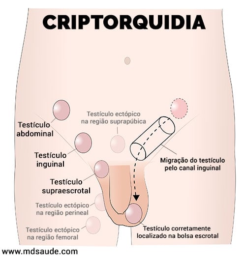 Criptorquidia - locais mais comuns