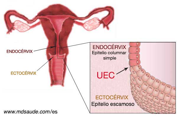 cuello-uterino-UEC