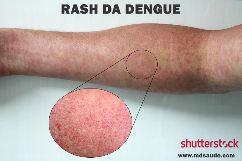 Rash da dengue