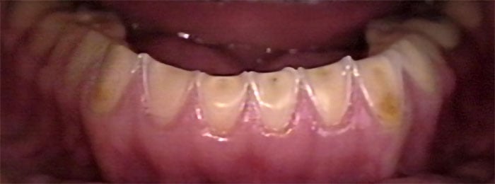 Erosão dentária na bulimia