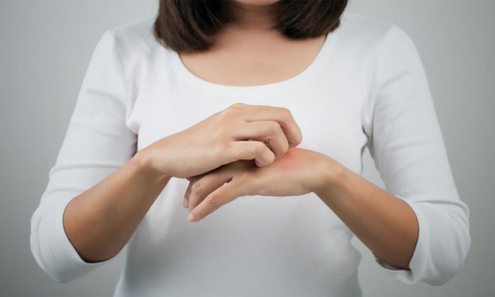 dermatite-atopica Dermatitis