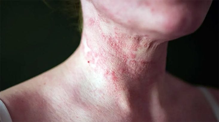 Dermatite atópica com lesão no pescoço.