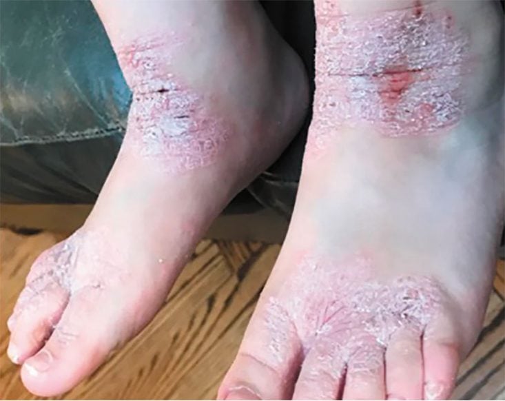 Adolescente com lesões de eczema atópico em tornozelos e pés