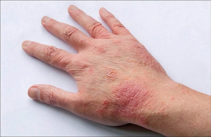 Eczema atópico na mão