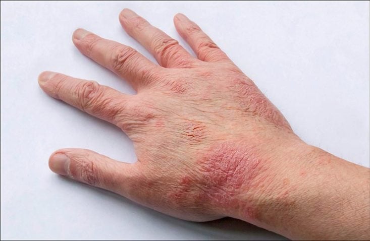Eccema atópico en la mano