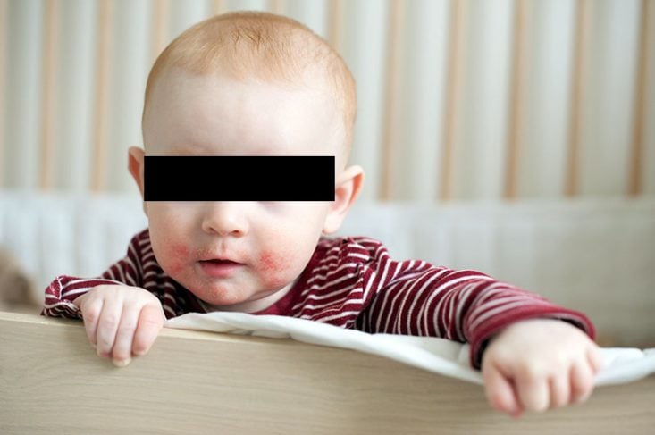 Dermatitis atópica en la cara de un bebé