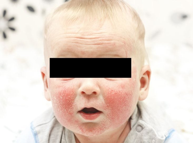 Eczema atópico fase infantil com acometimento extenso das bochechas