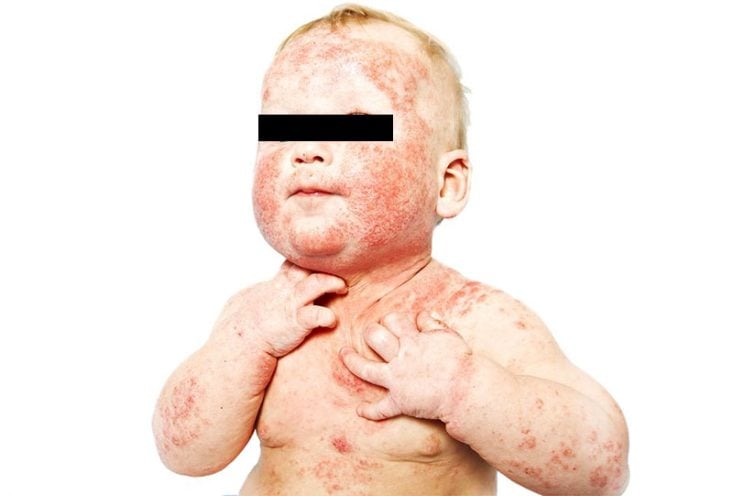 Dermatitis atópica infantil extensa
