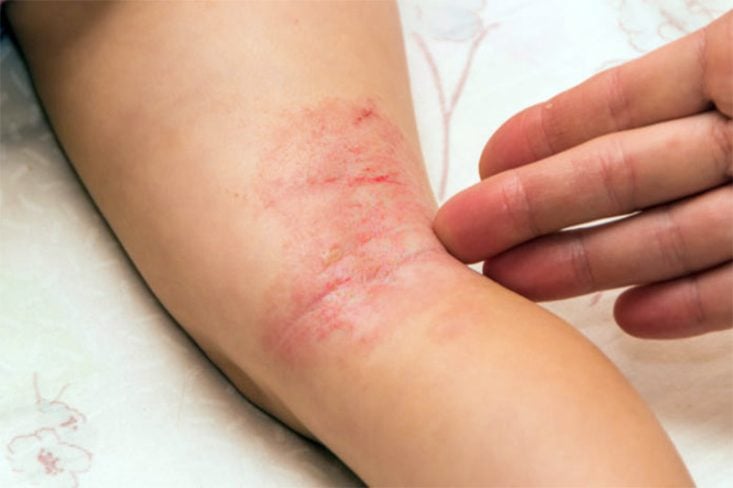 Eczema atópico na região poplítea