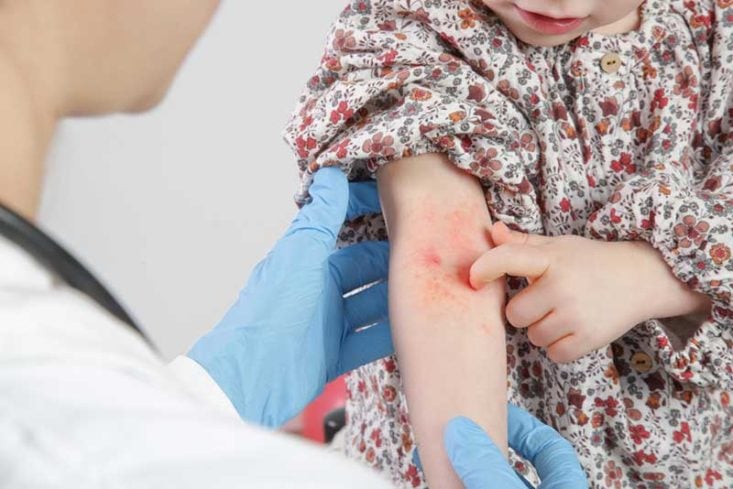 Eczema atópico en la fosa cubital