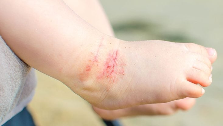 Eczema atópico no tornozelo
