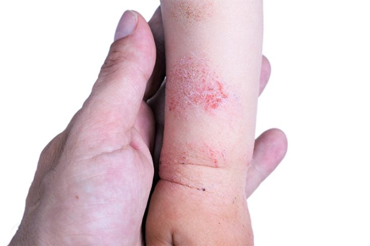 Dermatitis atópica en la muñeca y antebrazo