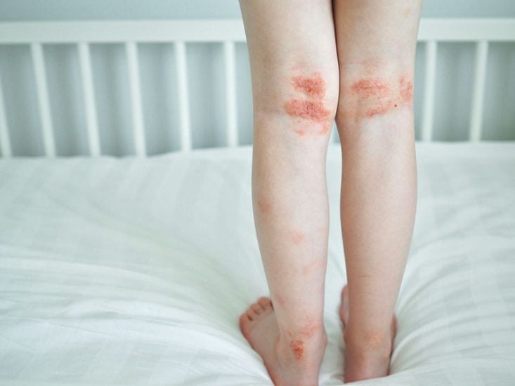 Eczema atópico na fossa poplítea e nos tornozelos