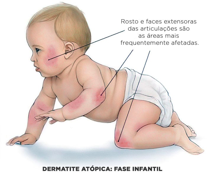 Dermatite atópica infantil