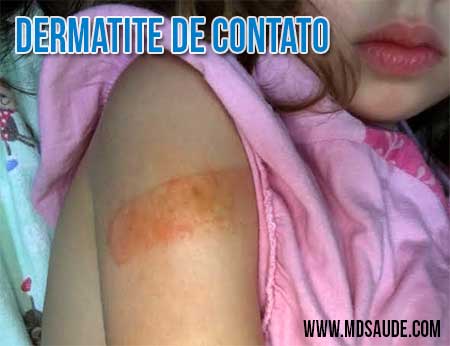 Dermatite de contato