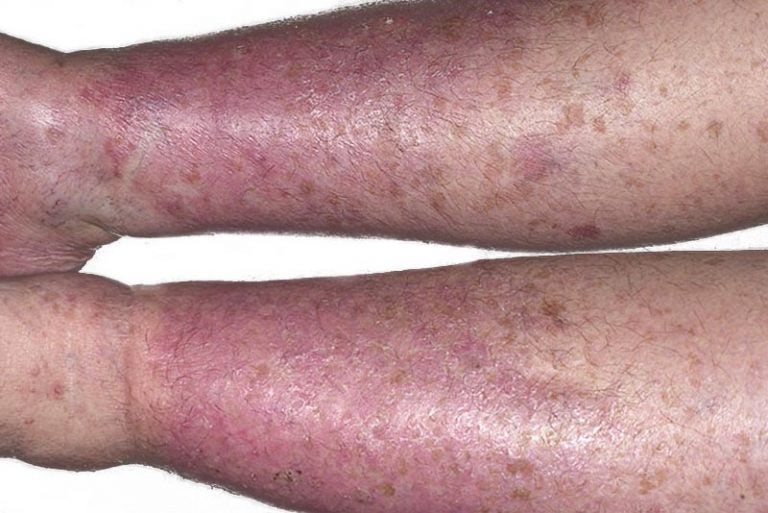 6 tipos de eczema causas, sintomas e tratamento MD.Saúde