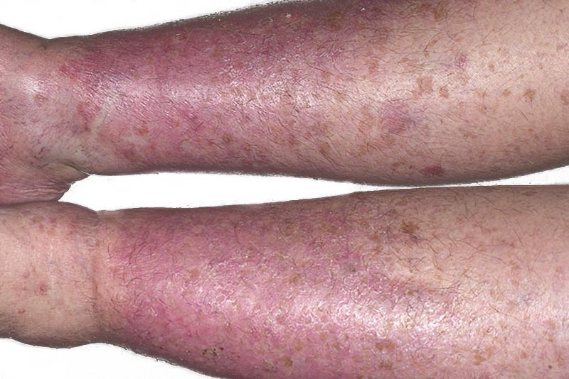 6 Tipos De Eczema Eccema Qué Es Síntomas Y Tratamiento Mdsaúde