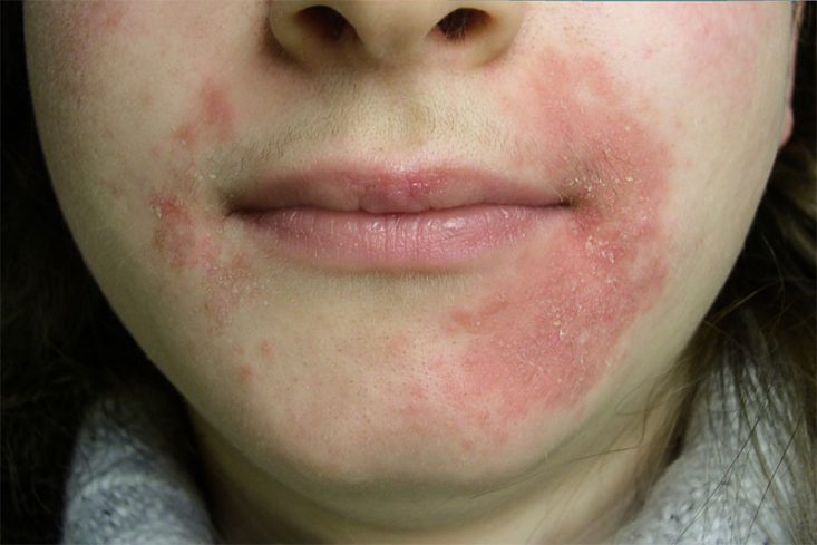 Dermatite perioral com eczema e descamação.