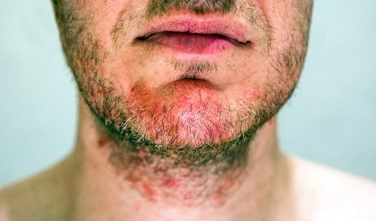 Dermatite seborreica na barba