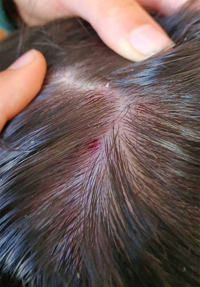 La Caspa En El Pelo. Dermatitis Seborreica Del Cuero Cabelludo