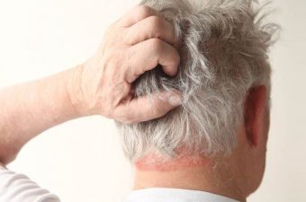 DERMATITIS SEBORREICA – Síntomas, causas y tratamiento