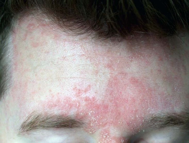 Dermatite seborreica no couro cabeludo, testa e sobrancelhas