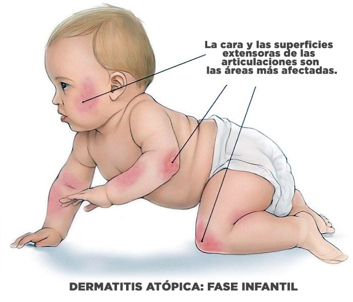Dermatitis atópica infantil