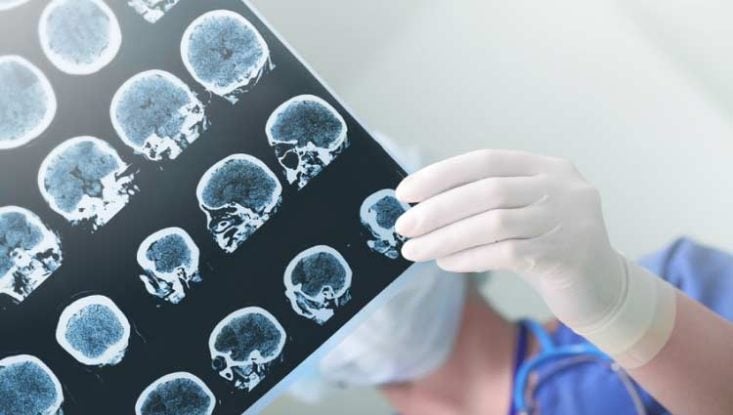 ACV (derrame cerebral): qué es, síntomas y tratamiento