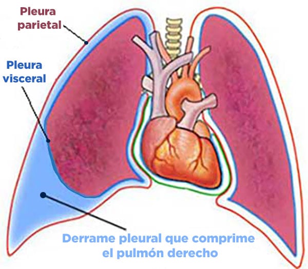 Compresión del pulmón por exceso de líquido pleural