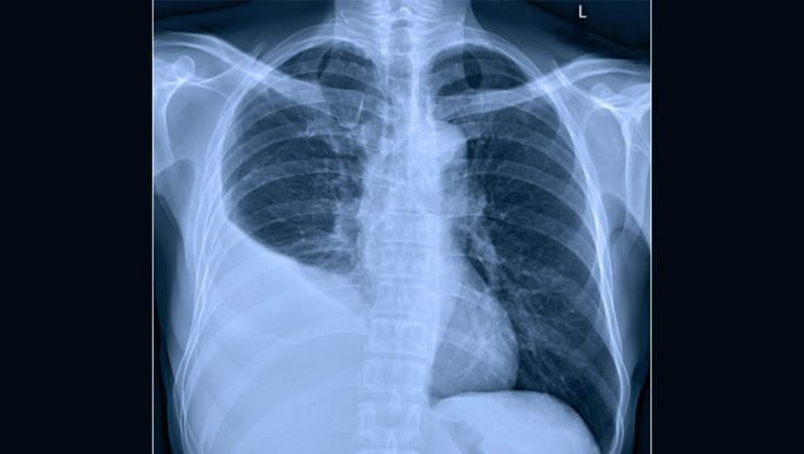 Gran derrame pleural en el pulmón derecho visto en la radiografía de tórax