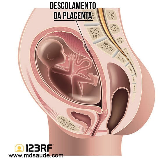Descolamento de placenta