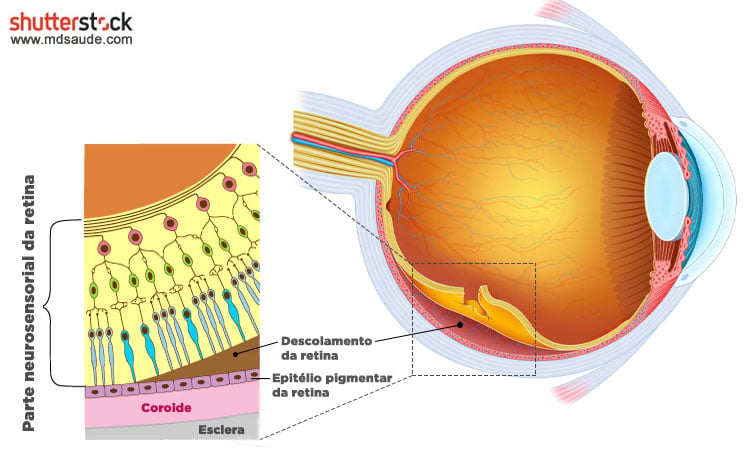 DESCOLAMENTO DE RETINA