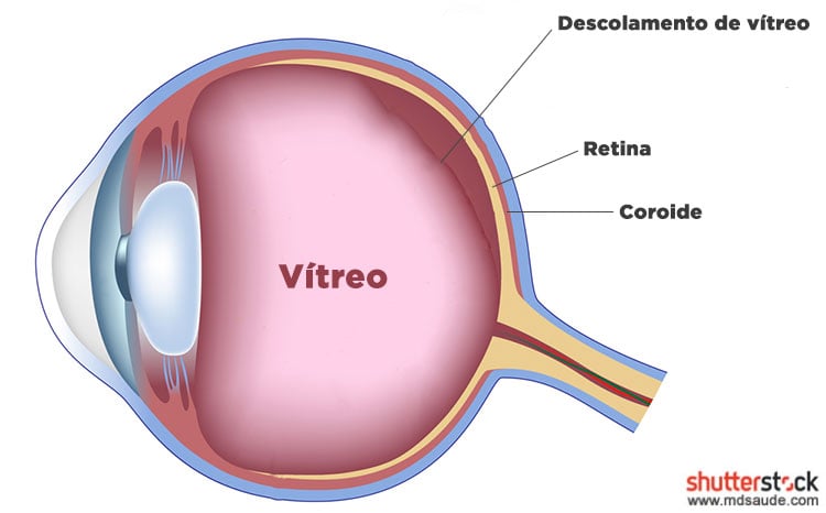 O que é o descolamento de retina?