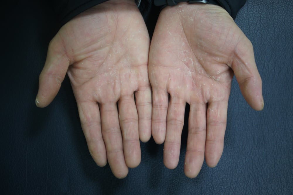 Descamación de las manos en la dishidrosis