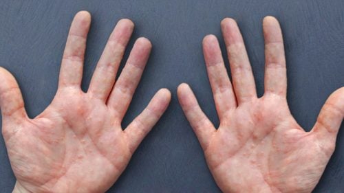 Dyshidrotic eczema: blisters on the hands, fingers, and feet