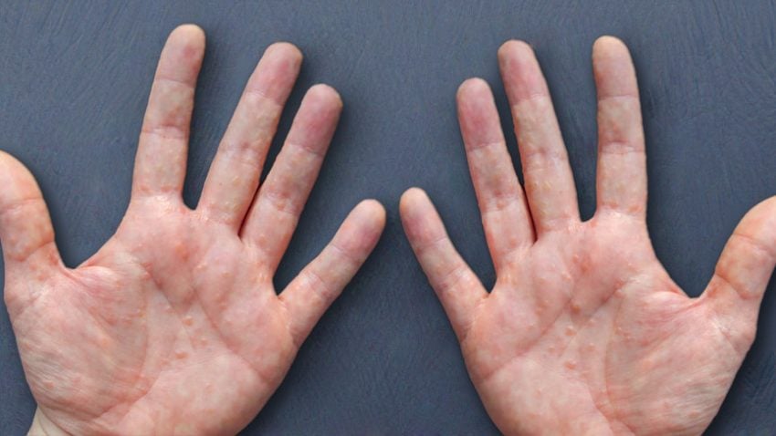 dishidrosis-causas-s-ntomas-y-tratamiento-md-sa-de