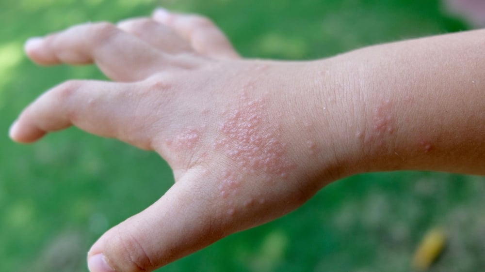 Eczema dishidrótico