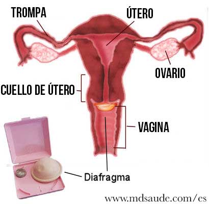 metodo anticonceptivo diafragma con espermicida
