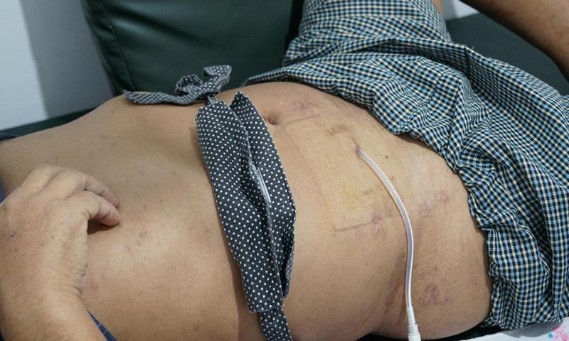 Cateter de diálise peritoneal