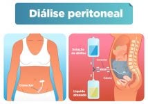 Diálise peritoneal: o que é e como é feita