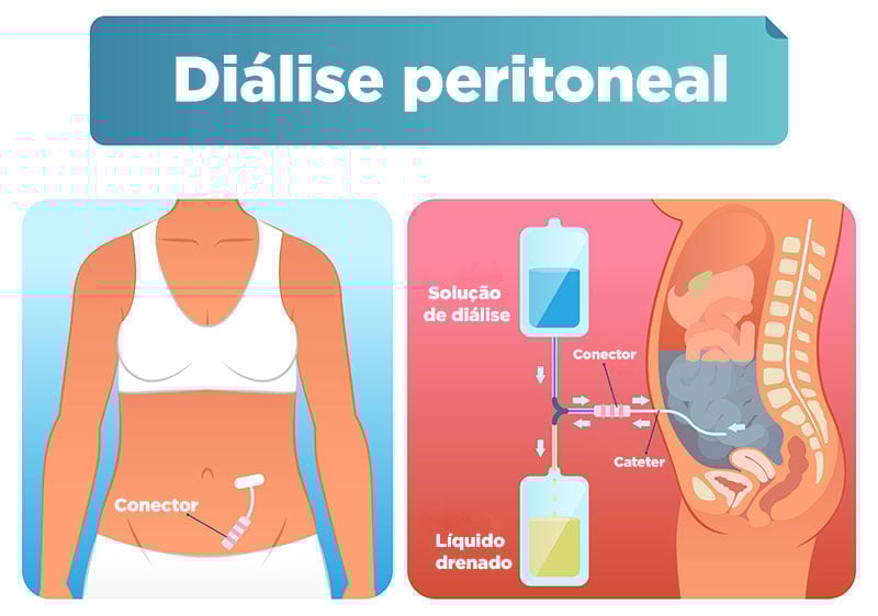 Diálise peritoneal