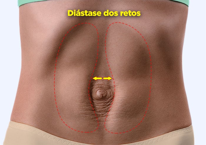 Diástase retal