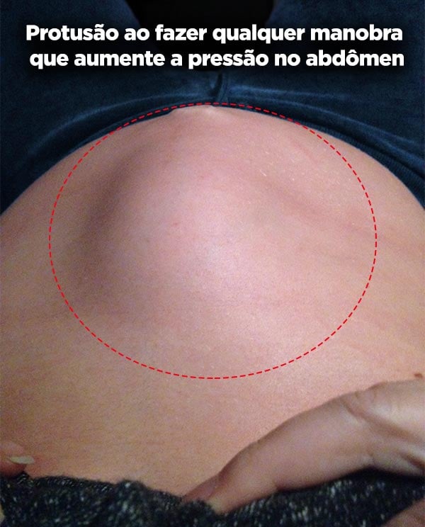 Diástase abdominal