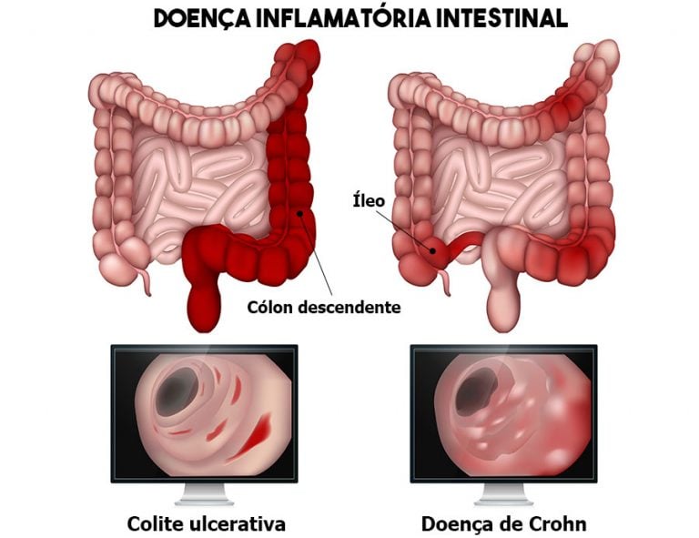 Doença de Crohn | O que é, sintomas, causas e tratamento