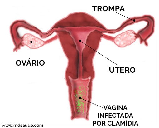 Quero um Bebê - SINTOMAS DE INFLAMAÇÃO NOS OVÁRIOS: A