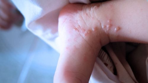 Photos of Dyshidrosis (Dyshidrotic Eczema)