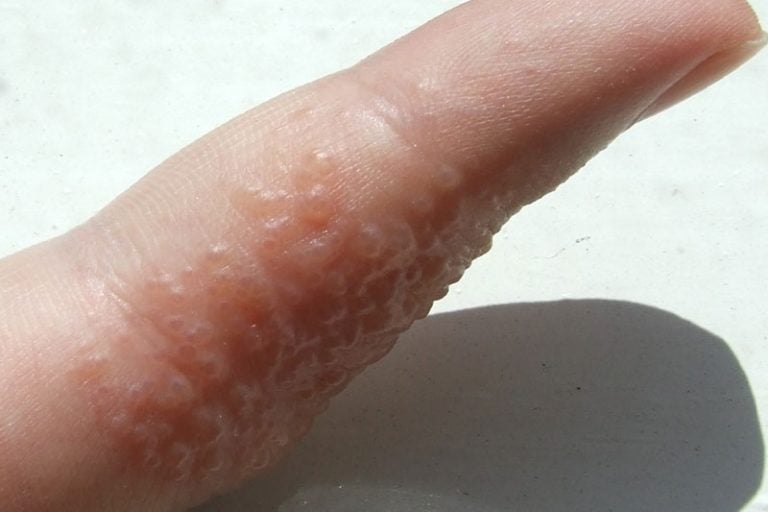 Photos of Dyshidrosis (Dyshidrotic Eczema)