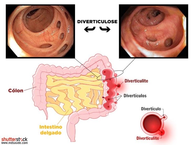 Diverticulite e diverticulose