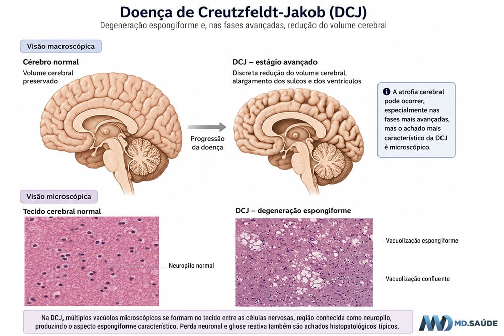 Degeneração espongiforme na doença de Creutzfeldt-Jakob.